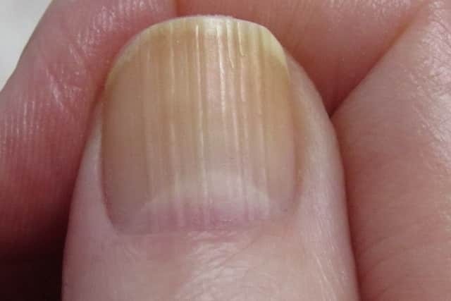 Vertical Ridges In Fingernails 1 