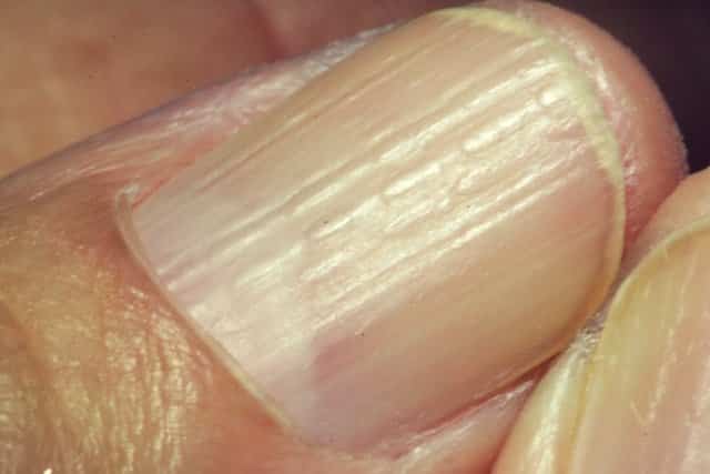 what-do-vertical-ridges-on-nails-mean-causes-and-prevention