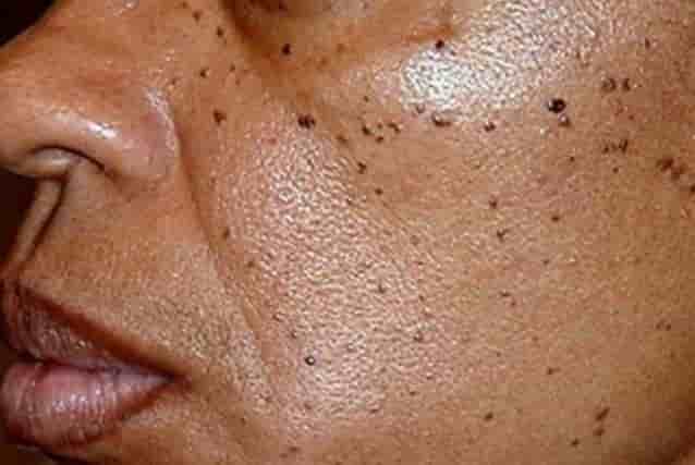 Black Spots On Skin Tiny 1 