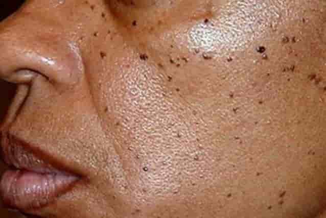 what-causes-dark-spots-on-skin-vrogue-co