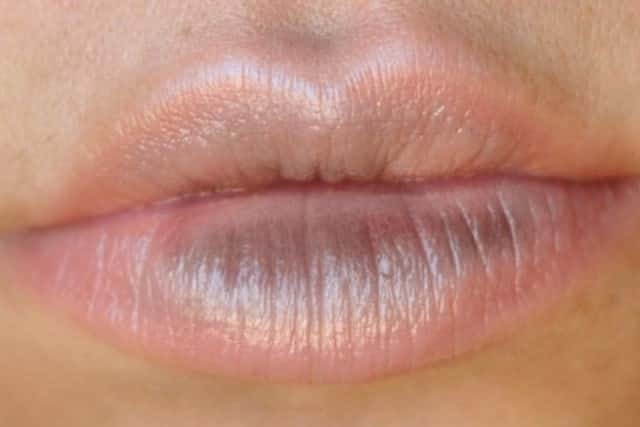 dry-patches-on-lip-upper-lower-pictures-causes-not-cold-sore