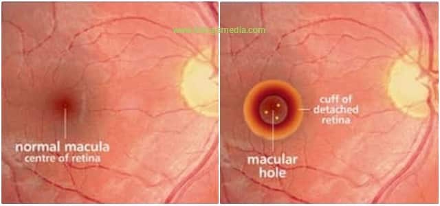 Can Diabetes Cause Black Spots In Vision