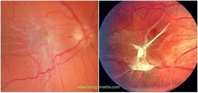 black-spots-in-vision-sudden-not-floaters-pictures-causes-get-rid