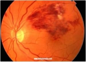 Black spots in vision - retina vascular occlusion
