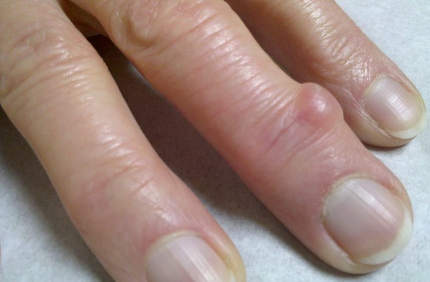 Lump on Finger, Joint Bone, Small, Hard, Painful, Pictures, Causes, Treatment & Home Remedies