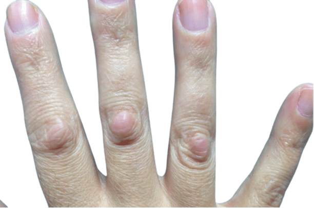 lump-on-finger-joint-hard-painful-pictures-causes-treatment